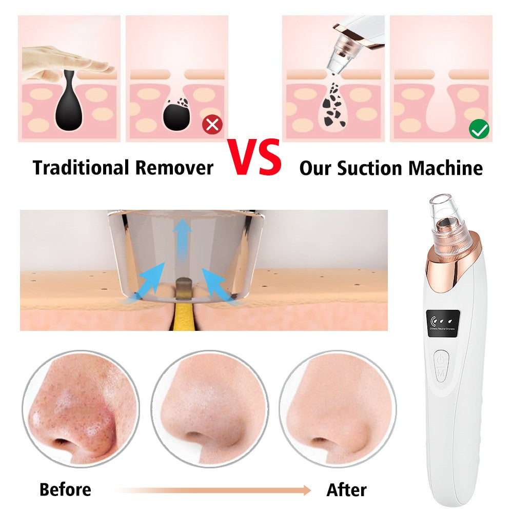 Blackhead Remover Vacuum with 3 Adjustable Suction Levels & Interchangeable Heads