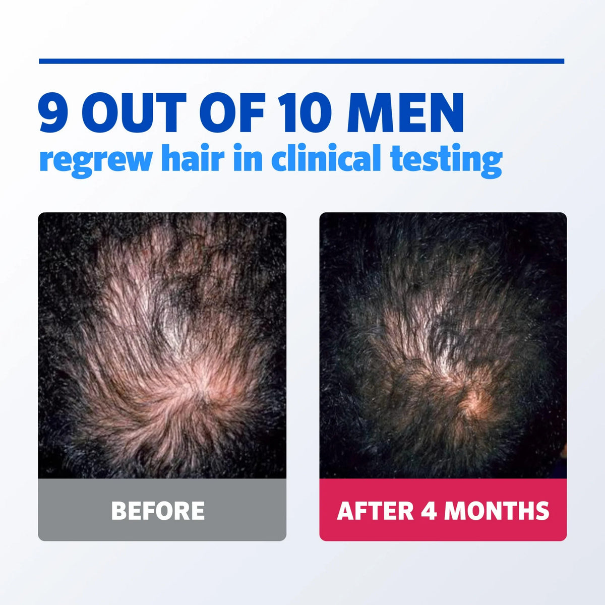 Minoxidil 5% Hair Regrowth Solution for Men 6-Pack