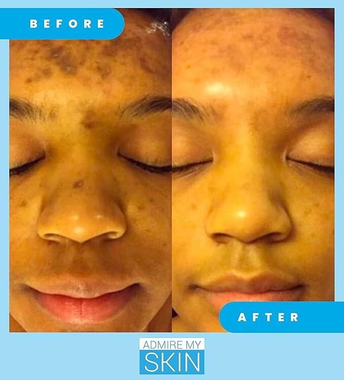 Dark Spot Corrector Serum for Face - Brightening Hyperpigmentation Treatment